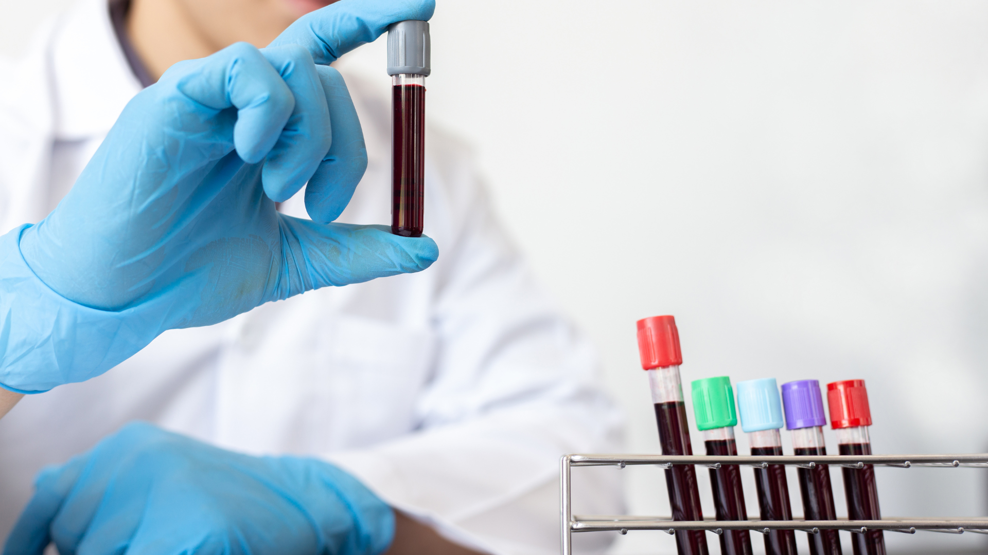 Nadpłytkowość (Wysokie Płytki Krwi) - Czy to Powód do Niepokoju? Wyjaśnia Hematolog